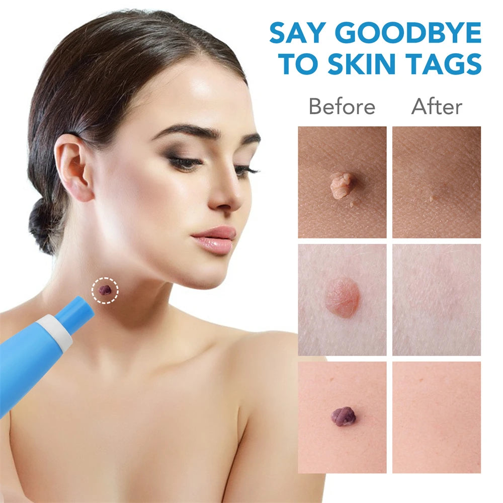 ✅ Skin Tag Remover Kit (2-in-1 Complete Set) – Say Goodbye to Skin Tags Painlessly & Naturally