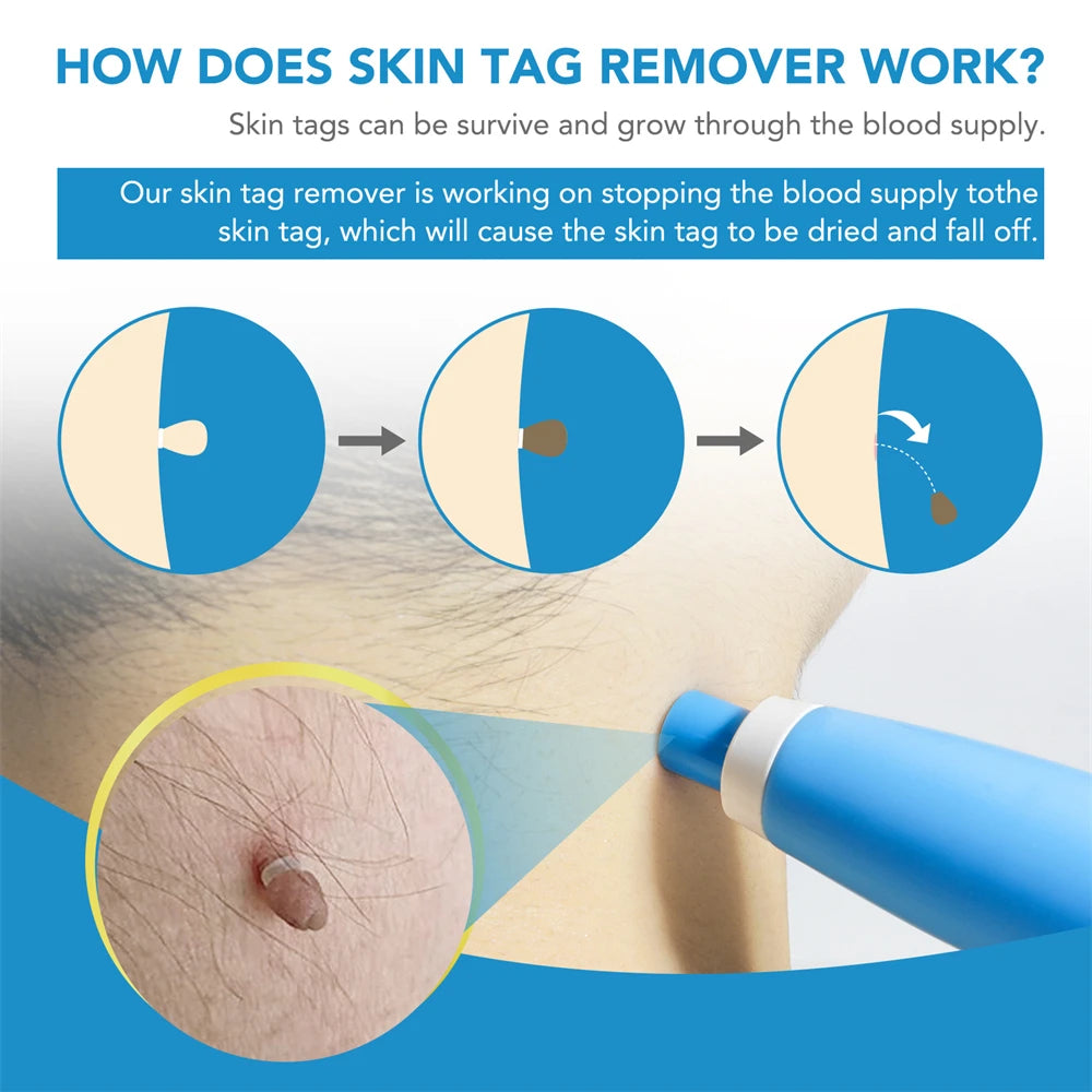 ✅ Skin Tag Remover Kit (2-in-1 Complete Set) – Say Goodbye to Skin Tags Painlessly & Naturally