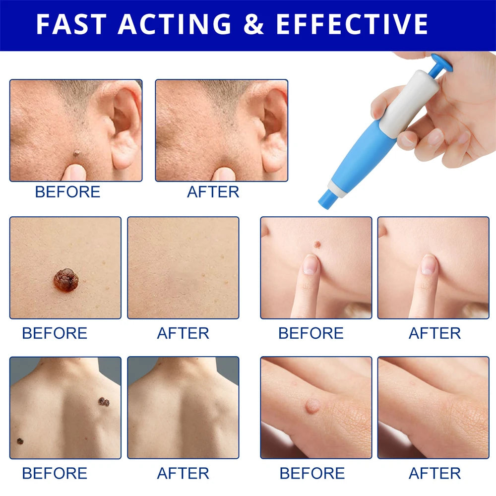 ✅ Skin Tag Remover Kit (2-in-1 Complete Set) – Say Goodbye to Skin Tags Painlessly & Naturally