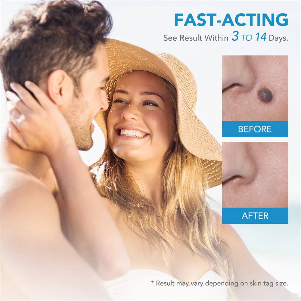 ✅ Skin Tag Remover Kit (2-in-1 Complete Set) – Say Goodbye to Skin Tags Painlessly & Naturally