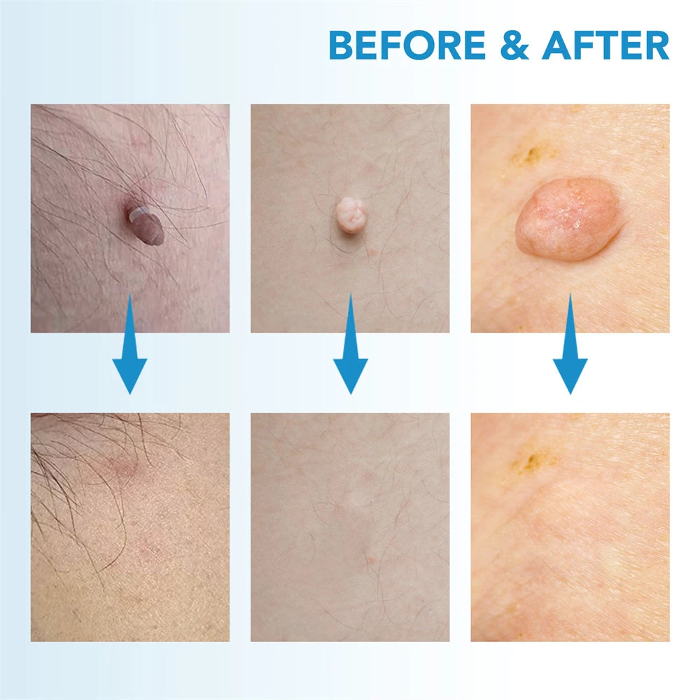 ✅ Skin Tag Remover Kit (2-in-1 Complete Set) – Say Goodbye to Skin Tags Painlessly & Naturally